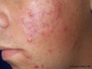 Symptômes de l'acné