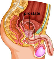problème de prostate à 20 ans)