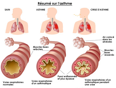 Résumé asthme infographie