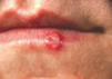 Airelles rouges - contre l'herpès labial