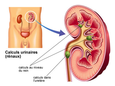 calculs urinaires introduction