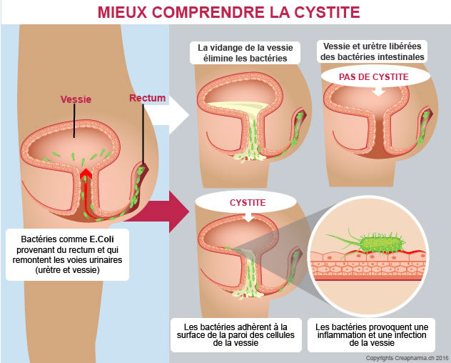 cystite-cause-infographie-2016