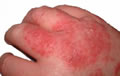 eczema définition