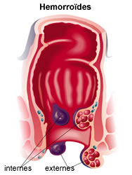 hemorroides-infographie