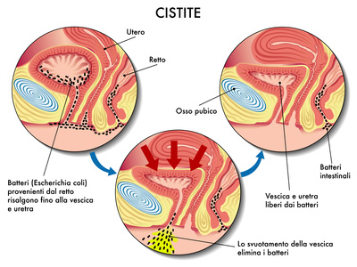 Cystite, on comprend mieux comment la bactérie E.Coli s’attache au tractus urinaire