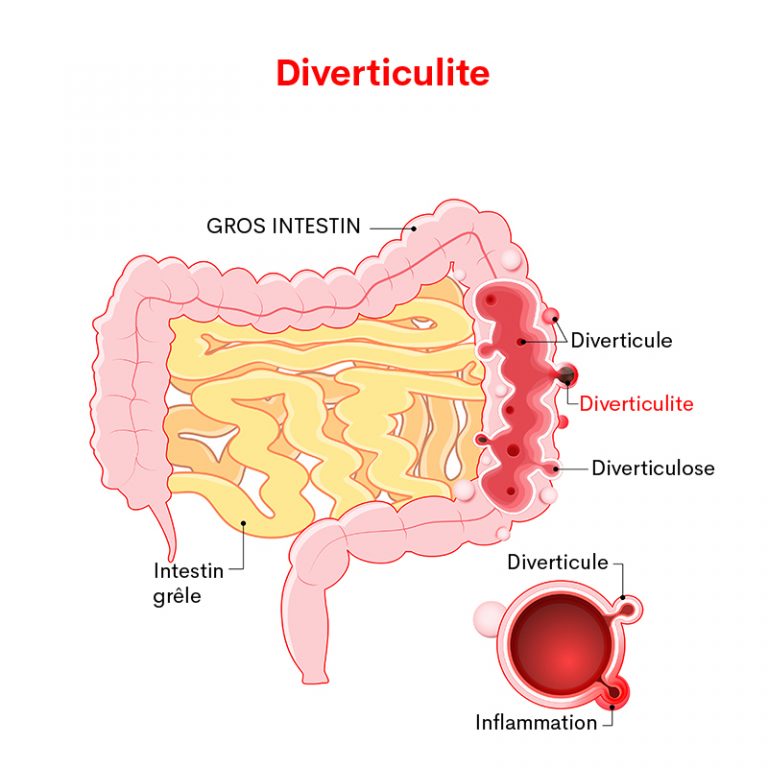 Diverticulite causes symptômes traitements Creapharma