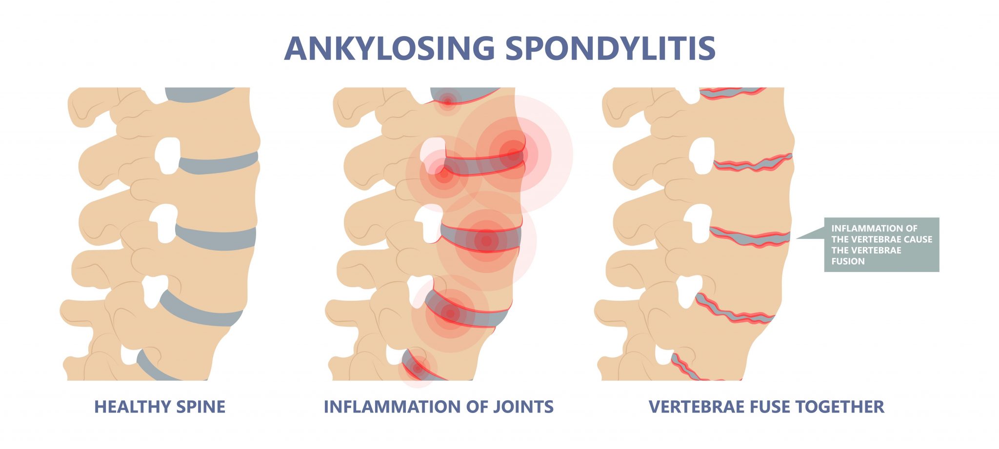 Ankylosing Spondylitis Osteoporosis Skeletal Pelvis Stiffness Chronic ...